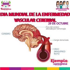 29 de octubre. Día mundial de la enfermedad cerebro vascular